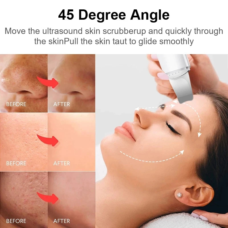 Xiaomi Ultrasonic Skin Scrubber Vibration Face Spatula Blackhead Remover Shovel Clean Cavitation Peeling Facial Lifting YOUPIN