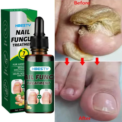Nail Repairing Liquid Essence Hand Care Foot Fungal Removal Repair Serum Anti-infective Paronychia Nail Polish Repair Products
