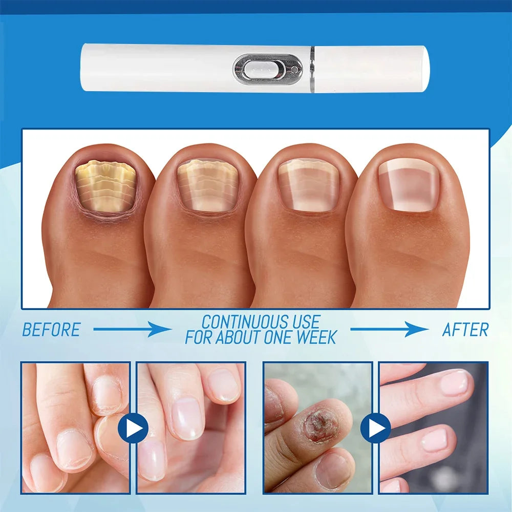 Nail Fungus Laser Pen Treatment Anti Fungus Infection Fungal Remove Dispel Onychomycosis Grow Foot Toe Fingernails Repair Care
