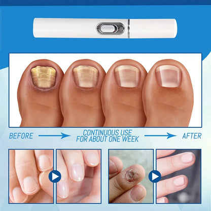 Nail Fungus Laser Pen Treatment Anti Fungus Infection Fungal Remove Dispel Onychomycosis Grow Foot Toe Fingernails Repair Care