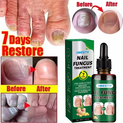Nail Repairing Liquid Essence Hand Care Foot Fungal Removal Repair Serum Anti-infective Paronychia Nail Polish Repair Products
