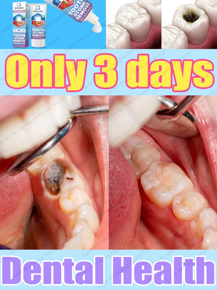 Healthy Teeth Remove Cavity Probiotics, 99% Repurchase