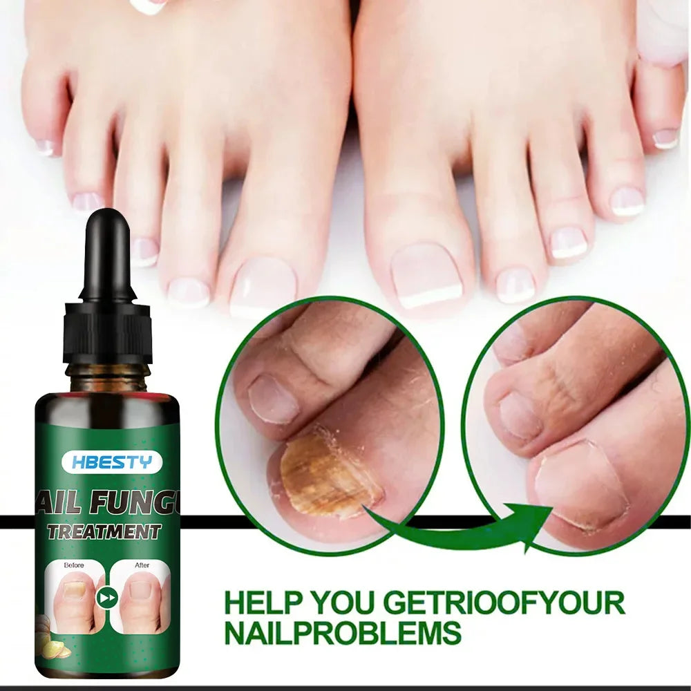 Nail Repairing Liquid Essence Hand Care Foot Fungal Removal Repair Serum Anti-infective Paronychia Nail Polish Repair Products