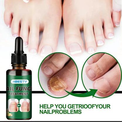 Nail Repairing Liquid Essence Hand Care Foot Fungal Removal Repair Serum Anti-infective Paronychia Nail Polish Repair Products