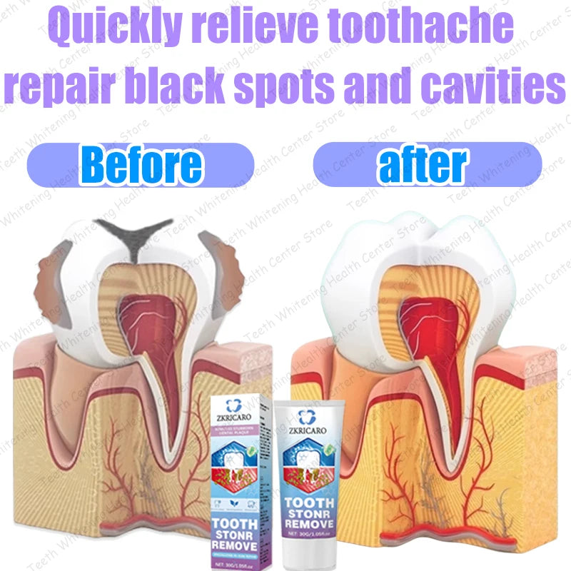 Healthy Teeth Remove Cavity Probiotics, 99% Repurchase