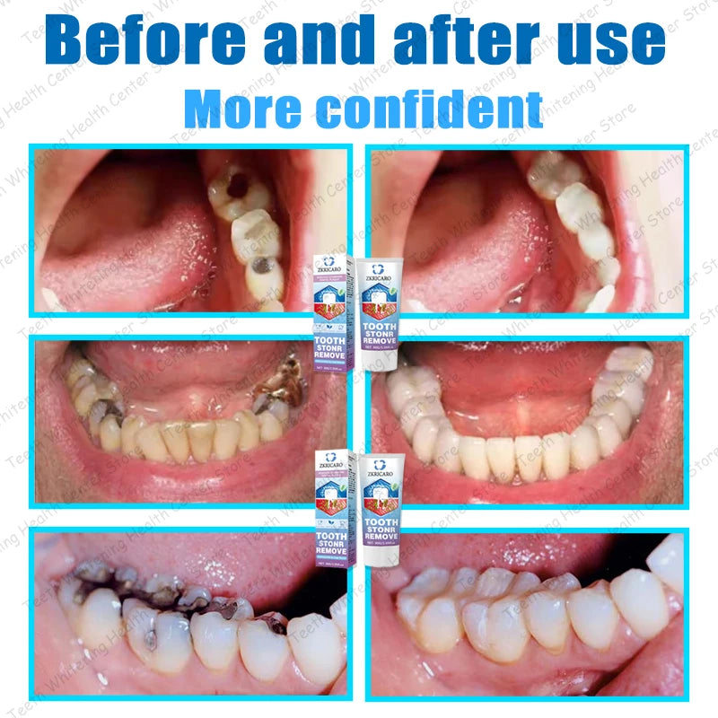 Healthy Teeth Remove Cavity Probiotics, 99% Repurchase