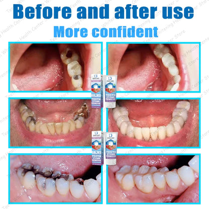 Healthy Teeth Remove Cavity Probiotics, 99% Repurchase