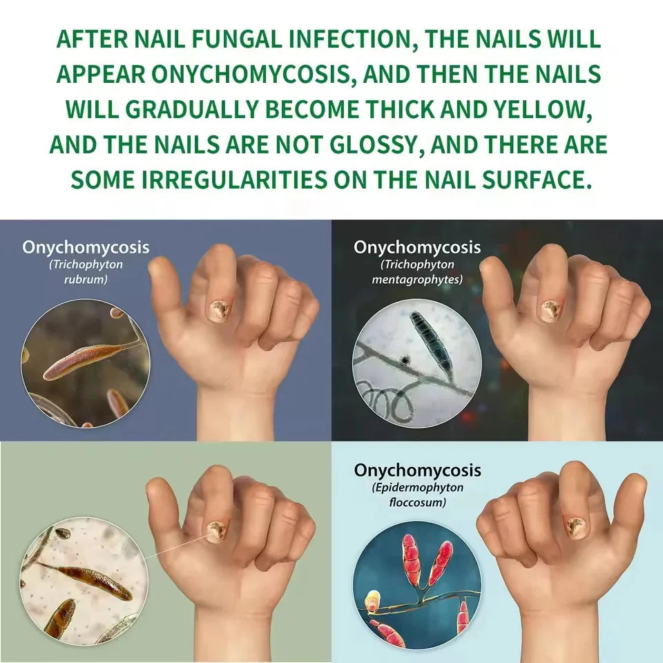 Nail Repairing Liquid Essence Hand Care Foot Fungal Removal Repair Serum Anti-infective Paronychia Nail Polish Repair Products