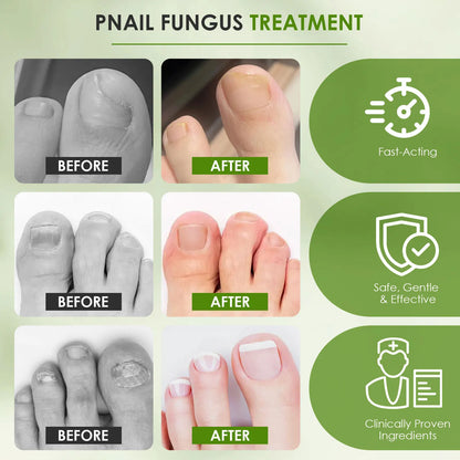 Nail Fungus Repair Essence Pen 3ml*4 Repair Fingernail 25%Undecylenic Acid Restores Appearance of Discolored Nail Foot Care Tool