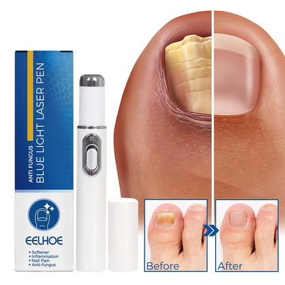 Nail Fungus Laser Pen Treatment Anti Fungus Infection Fungal Remove Dispel Onychomycosis Grow Foot Toe Fingernails Repair Care